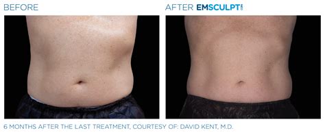 emsculpt hawaii|EMSCULPT NEO® BODY SCULPTING .